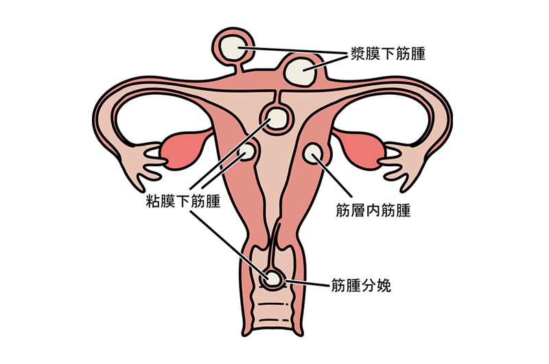 子宮筋腫とは